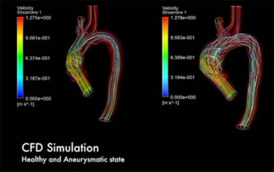 Simulation of a virtual patient used to analyze the blood flow and blood pressure alterations for aneurysms