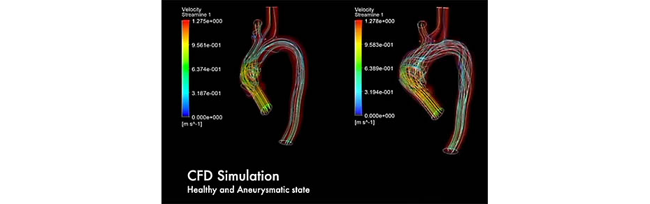 Simulation of a virtual patient used to analyze the blood flow and blood pressure alterations for aneurysms