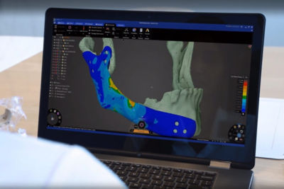 TECHFIT simulates surgical implants using Ansys Discovery