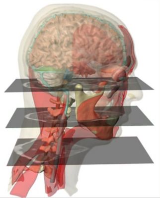 MRI of a concussion in the brain