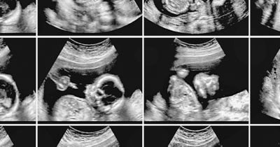 King’s College London Reduces Congenital Heart Defect Diagnostic Risks With Neonatal Digital Twins