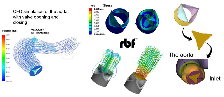 使用 Ansys 在心跳中诊断动脉瘤的图3