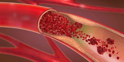 Another of Dr. Bjaskaran's Innovation Courses explains how to model 3D internal bloodflow in a bifurcating artery.