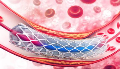 Visualization of a stent in an artery