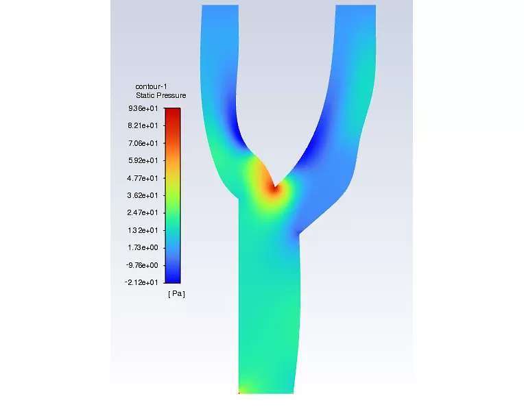 Blood Flow in Clogged Artery CFD Simulation by ANSYS Fluent Training - MR  CFD