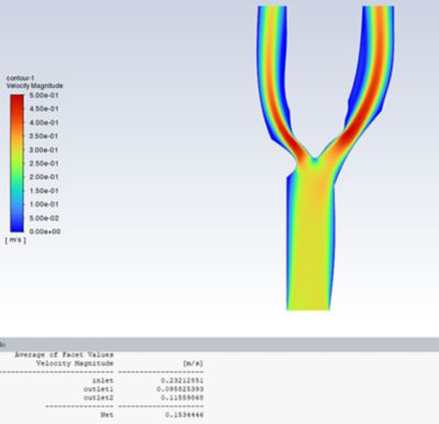 Carotid artery stage 3 velocity 