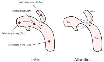 Coarctation of the aorta