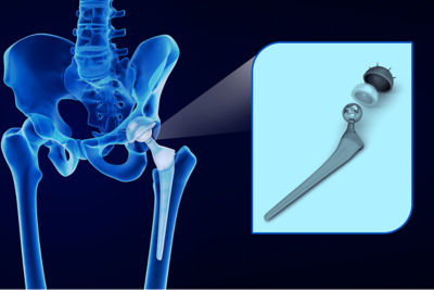 Level 3 Industrial Case Study: Biomaterials Selection for a Joint Replacement