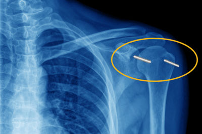 Caso Práctico Industrial de Nível 3: Implante de anclaje de sutura