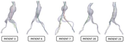 endovascular-aneurysm-repair-simulation