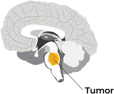 Initial vs clinical vs computational outcomes