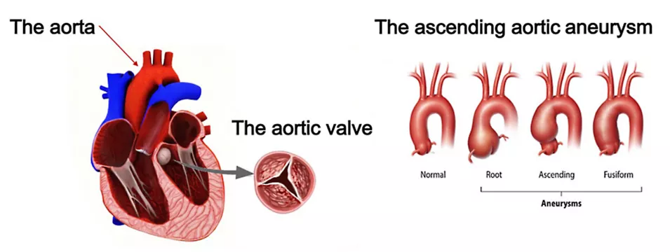 Ascending Aortic Aneurysm Nonsyndromic Heritable Thoracic Aortic