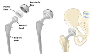 Case Study: Simulation-driven design for a Joint Replacement in Ansys Discovery