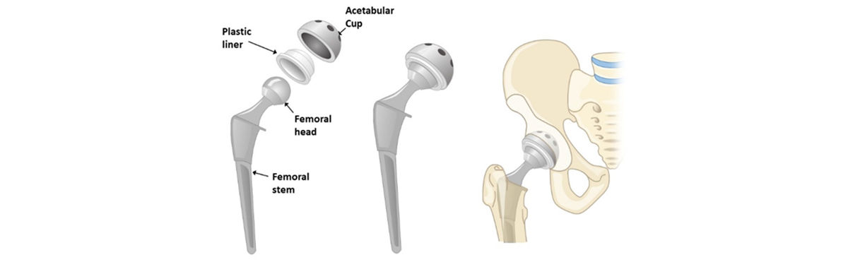 Case Study: Simulation-driven design for a Joint Replacement in Ansys ...