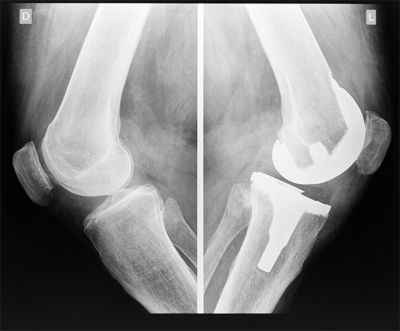 X-ray of a knee and an artificial knee