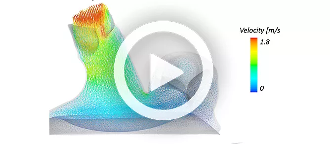 Blood Flow in Clogged Artery CFD Simulation by ANSYS Fluent Training - MR  CFD