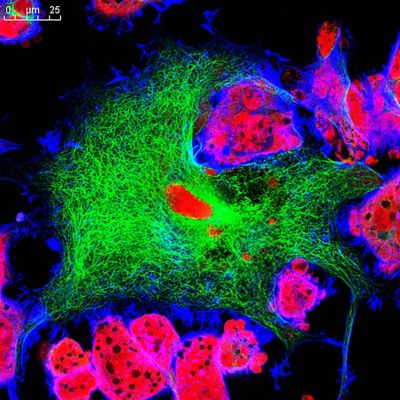 Neuroblastoma