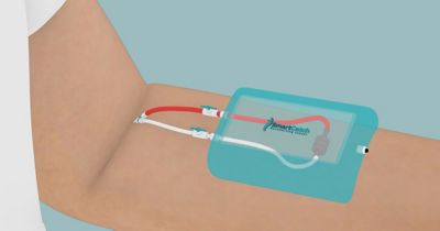 Representation of the CTC-Pheresis concept.