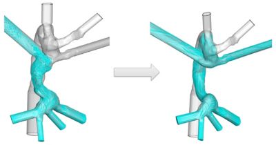 Simulation: The Heart and Soul of Preoperative Planning