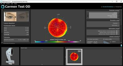 optimeyes-interface-for-ophthalmologists-with-ansys-mechanical-embedded-sm.jpg