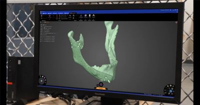 repairing-bone-loss-with-simulation-3.jpg