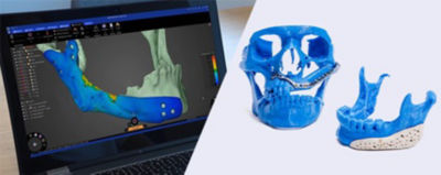 Repairing Bone Loss with Simulation-Generated, Patient-Specific Implants