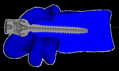 screw-loosening
