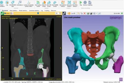 optimize personalize implants