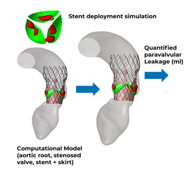 Stent deployment