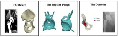 sw-rnoh-ucl-implant-design.jpg