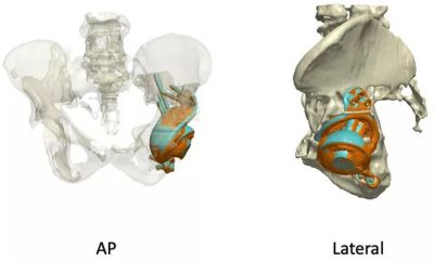 sw-rnoh-ucl-implant-migration.jpg