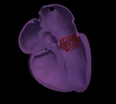TAVR