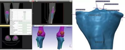 tibia-segmentation.jpg