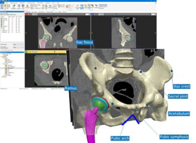 Simpleware ScanIP Medical, combined with Ansys simulation software, helps clinicians build reliable models for pre-surgical planning.